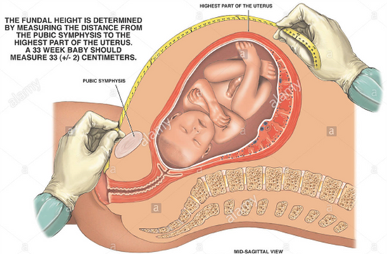 Low Dose Aspirin in the Prevention of Pre eclampsia and Fetal Growth Restriction